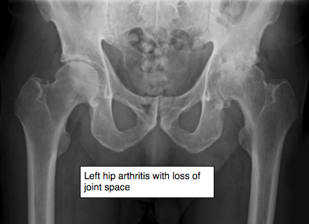 hip-arthritis-img1