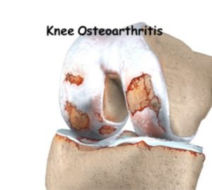 knee-arth-img1