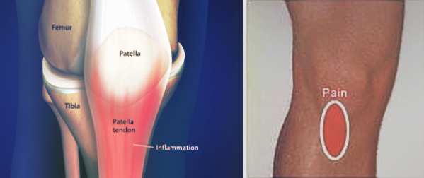 patella-tendon-img1